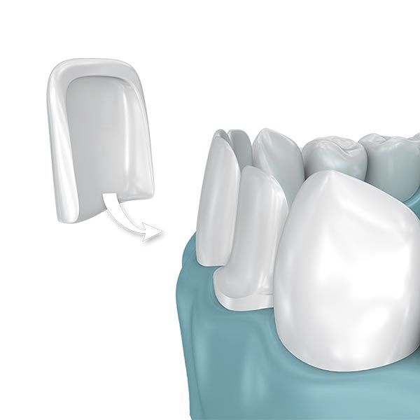 An illustration of a veneer being placed on a tooth