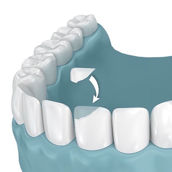 An illustration of dental bonding material being used to restore a chipped tooth